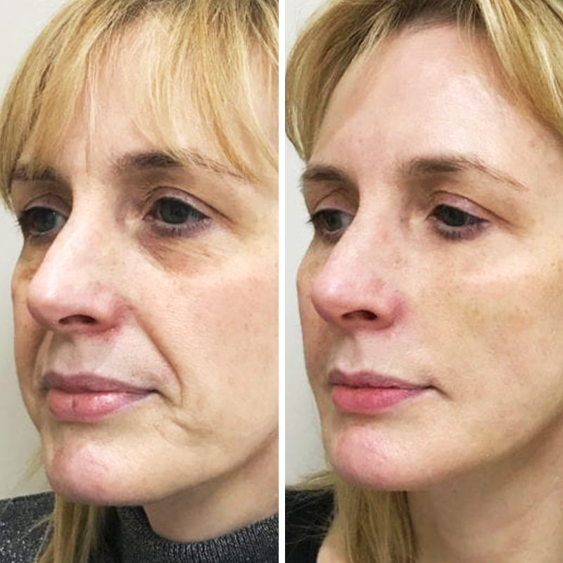 InstaLift | Lift your face and remove wrinkles forever!