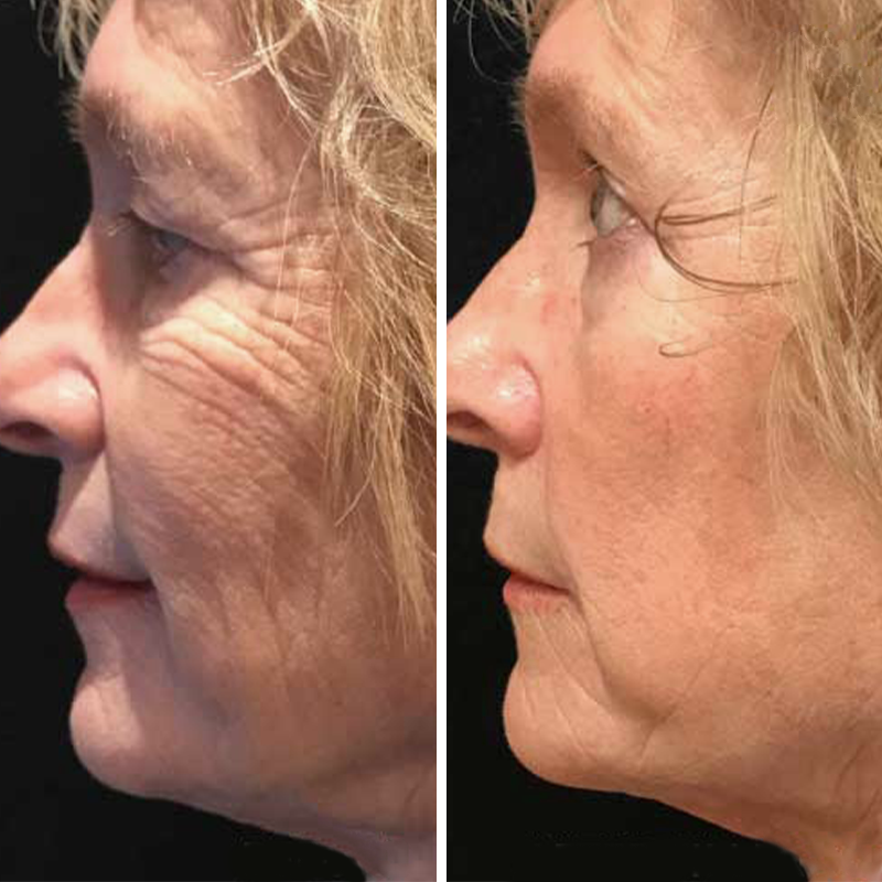 InstaLift | Lift your face and remove wrinkles forever!